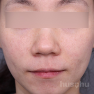 흉터 시술 후 이미지