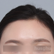 이마필러 시술 후 이미지