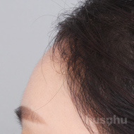 이마필러 시술 후 이미지