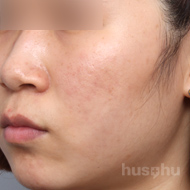 여드름 시술 후 이미지