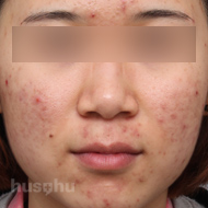 여드름 시술 전 이미지