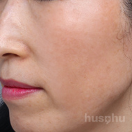 기미색소 시술 후 이미지