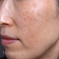 기미색소 시술 전 이미지